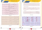 دانلود کتاب تفسیر الکتروکاردیوگرام کسری قادری (PDF📁) 351 صفحه-1